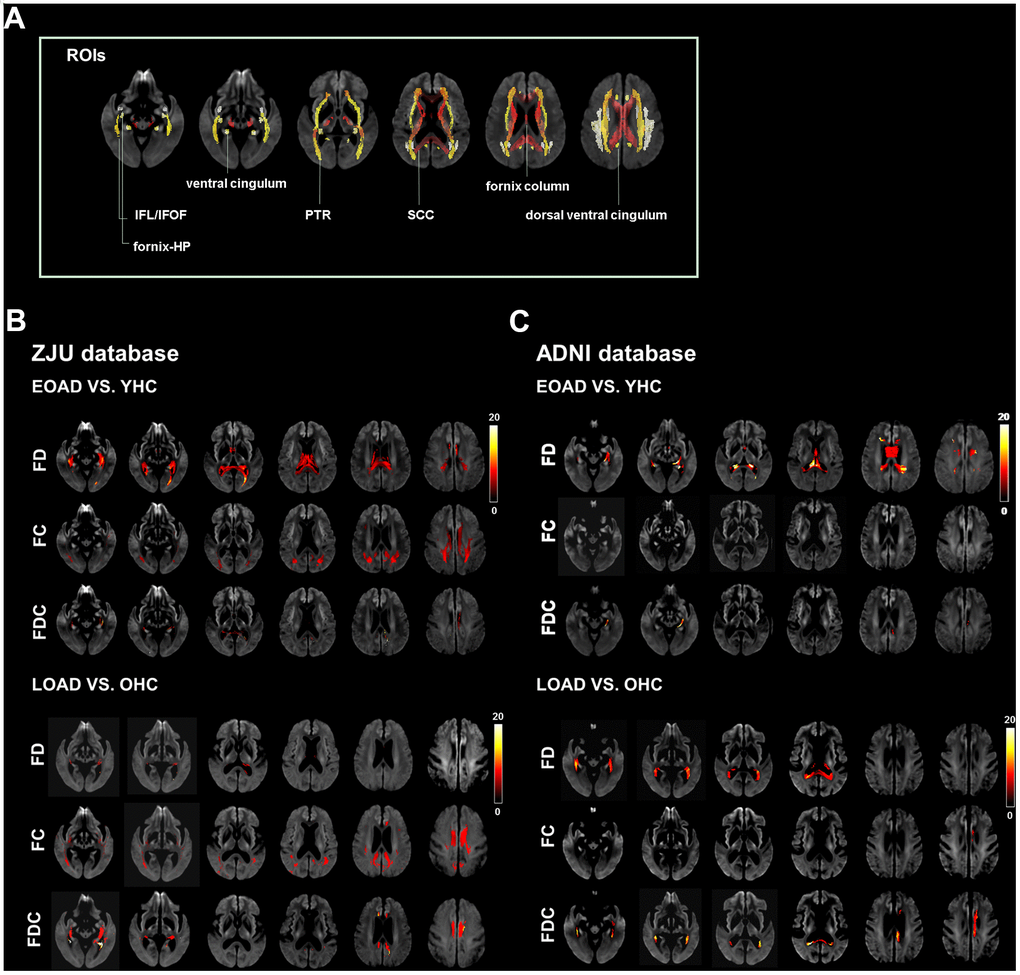 Illustrates the location reference and fiber tract-specific reduction in EOAD/LOAD versus controls from whole-brain fixel-based analysis. (A) illustrates the location reference. (B) and (C) Represent results from ZJU and ADNI databases, respectively. We color-coded the significant streamlines by the effect size expressed as a percentage relative to the control groups. Abbreviations: ZJU, Zhejiang University; FD, fiber density; FC, fiber bundle cross-section; FDC, fiber density and bundle cross-section.