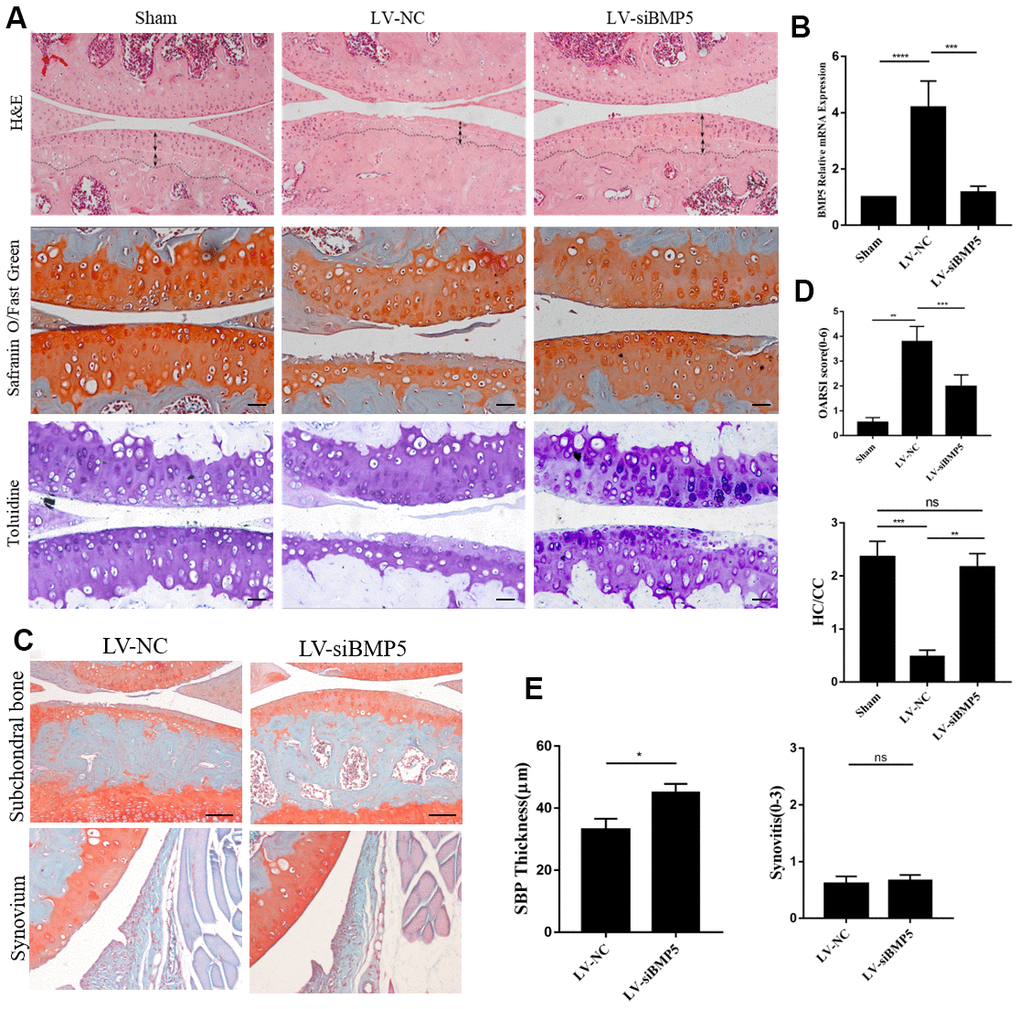 Deletion of BMP5 attenuates osteoarthritis in the in vivo DMM model mice. (A) Representative images show hematoxylin and eosin (H&E) staining, toluidine staining and Safranin O-Fast Green staining of knee cartilage tissue sections from LV-siBMP5 and LV-siNC group mice (n=5 per group). (B) RT-PCR results show BMP5 mRNA levels in LV-siBMP5 and LV-siNC group mice at 2 weeks post-DMM surgery (n = 5 per group). (C) Representative images show synovitis and SBP thickness in the sham-operated, DMM plus LV-siNC, and DMM plus LV-siBMP5 groups of mice at 4 weeks post-DMM operation. (D) OARSI scores and hyaline cartilage/calcified cartilage ratios in sham-operated, DMM plus LV-siNC, and DMM plus LV-siBMP5 groups of mice at 4 weeks post-DMM operation. (E) Quantitative analysis shows the status of synovitis and SBP thickness in the sham-operated, DMM plus LV-siNC, and DMM plus LV-siBMP5 groups of mice at 4 weeks post-DMM operation. All data are represented as the means ± SD (n=5 per group); scale bars: 5 μm.