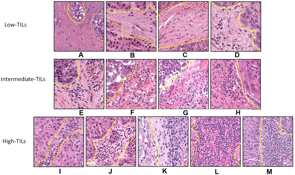Histopathologic examples of lymphocytic infiltration in hepatocellular carcinoma on H&E-stained tumor sections. Example of tumors with varying intensity of stromal TILs by H&E: (A) 1%, (B) 1%, (C) 5%, (D) 5%, (E) 10%, (F) 20%, (G) 30%, (H) 40%, (I) 50%, (J) 60%, (K) 70%, (L) 80%, and (M) 90%.