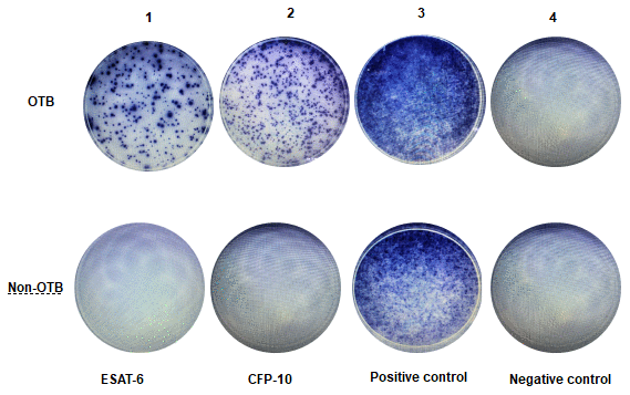 Representative examples of T-SPOT.TB assay in non-OTB and OTB patients. This figure shows representative results of the T-SPOT.TB assay from two patients. Figure 2-OTB shows a positive result from an OTB patient. Figure 2-Non-OTB shows a negative result from a non-OTB patient.