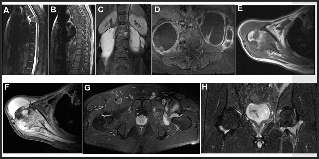 Representative examples of MRI in OTB patients. (A, B) Thoracic spine tuberculosis: showing destruction of vertebral and paravertebral abscess. (C, D) Lumbar spine tuberculosis: showing destruction of vertebral and psoas abscess. (E, F) Right shoulder tuberculosis: showing worm like destruction of the right humeral head with effusion in the articular cavity. (G, H) Left hip joint tuberculosis: showing left hip joint synovitis and synovial fluid.