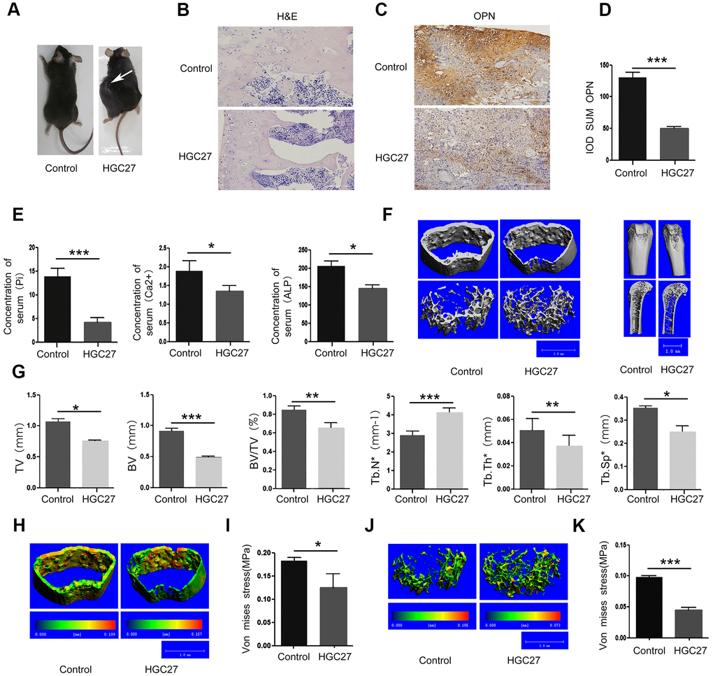 Injection of C57BL mice with HGC27 cells in vivo confirms that gastric cancer induces bone loss. (A) C57BL mice were injected with HGC27 cells or PBS (control). Mice were observed for 90 days following the injection. The white arrow indicates the localization of the gastric tumor. (B) H&E staining of isolated femurs from the control group and the experimental group. Scale bar, 100μm. (C) Immunohistochemical staining of osteopontin (OPN) from representative normal and damaged femoral tissues. The brown color indicates OPN-positive cells. Scale bar, 100 μm. (D) Comparison of IOD SUM of OPN-positive cells in (C). (E) Peripheral blood of C57BL mice injected with PBS or HGC27 cells was collected 90 days post-injection for determination of serum phosphorus (Pi), calcium (Ca2+) and alkaline phosphatase (ALP) respectively. (F) Micro-CT showing the transverse section and longitudinal section of the femur. (G) Quantitative analysis of the percentage of total bone mass (TV), bone mass (BV), bone volume to total bone volume (BV/TV), trabecular number (Tb.N*), trabecular thickness (Tb.Th*) and trabecular spacing (Tb.Sp*) in femurs from the two groups at day 90. (H) Micro-CT showing a comparison of the stress levels of the femoral cortical bone. (I) Quantitative analysis of the ability of the femoral cortex to withstand stress. (J) Micro-CT showing a comparison of the stress tolerance of the femoral trabecular cancellous bone. (K) Quantitative analysis of the femoral trabecular cancellous bone portion subjected to stress. Data are shown as mean±SEM. Statistical differences were obtained using a Student's t-test, *, p