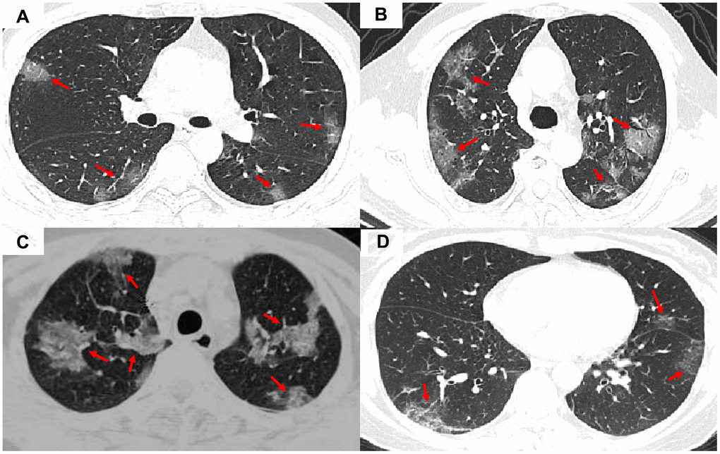 Representative images of COVID-19 pneumonia, adenovirus pneumonia, cytomegalovirus pneumonia, and influenza virus pneumonia. (A) A transverse CT image from a 35-year-old man with adenovirus pneumonia showing bilateral ground-glass opacities in the upper lobes with a rounded morphology (arrows). (B) COVID-19: A transverse CT image from a 57-year-old man with COVID-19 showing more limited ground-glass opacities in the bilateral upper lobes with an elliptical morphology (arrows). (C) A transverse CT image obtained in a 45-year-old female with cytomegalovirus pneumonia showing bilateral ground-glass and burr-like, denser, and less transparent distribution (arrows). (D) A transverse CT image of a 61-year-old man diagnosed with influenza virus pneumonia showing bilateral ground-glass opacities in the upper lobes (arrows).