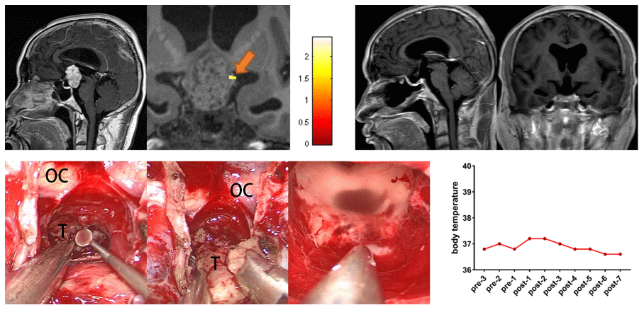 Preoperative midsagittal contrast-enhanced T1-weighted MRI scans showed a suprasellar solid tumor, and the coronal task-related fMRI showed the activated POAH of the hypothalamus in case 19. The orange arrow indicated the activated POAH. The postoperative sagittal and coronal contrast-enhanced T1-weighted MRI showed that GTR was achieved. Intraoperative photographs of subject 19 showed that the tumor was not tightly adhered to the surrounding tissues, and the tumor was sharply separated from the surrounding tissues through the CPC approach. After complete resection of the tumor, the midbrain aqueduct and hypothalamus could be observed. No significant increase in body temperature was observed during the perioperative period. fMRI: functional magnetic resonance imaging; POAH: preoptic and anterior hypothalamic region; GTR: gross total resection; CPC: chiasm-pituitary corridor; OC: optic chiasma; T: tumor.