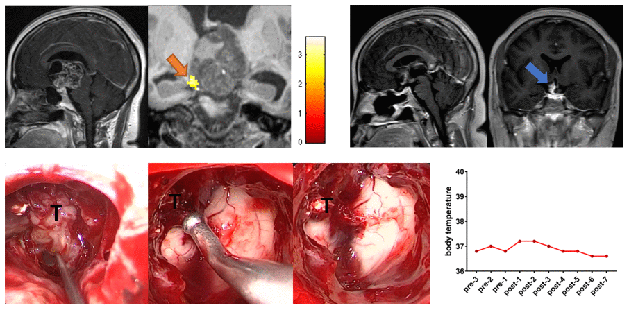 Preoperative midsagittal contrast-enhanced T1-weighted MRI scans revealed a large solid tumor extending up into the third ventricle, and the coronal task-related fMRI showed the activated POAH of the hypothalamus in case 3. The orange arrow indicated the activated POAH. The postoperative sagittal and coronal contrast-enhanced T1-weighted MRI showed that NTR was achieved. The blue arrow indicated the tumor that unremoved. Intraoperative photographs showed that the tumor adhered tightly to the surrounding tissues, especially the POAH of the hypothalamus, which was localized preoperatively. To protect the function of the hypothalamus, the part of the tumor that adhered closely to the hypothalamus was not forcibly removed. No significant increase in body temperature was observed during the perioperative period. fMRI: functional magnetic resonance imaging; POAH: preoptic and anterior hypothalamic region; NTR: near-total resection; T: tumor.