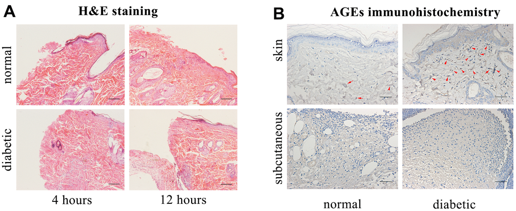 Hematoxylin and eosin (H&E) staining, advanced glycation end products (AGEs) immunohistochemical staining. (A) H&E staining. Scale bar as 0.1mm. (B) AGEs immunohistochemical staining (Red arrows indicate positive expressions). Scale bar as 0.025mm.