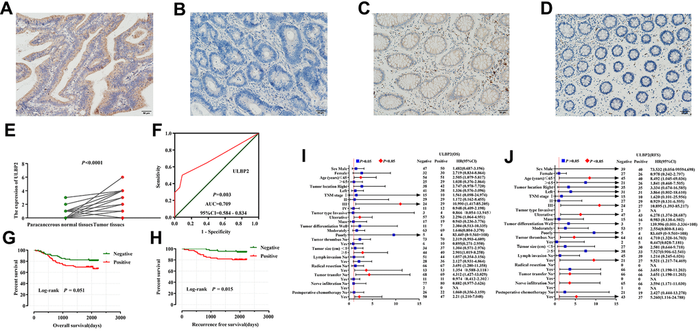 Immunohistochemical staining analyses of ULBP2 expression in COAD tumor tissues and adjacent normal tissues. (A–D) ULBP2 staining results were observed in the cytoplasm of colon cells; (A) Positive staining of COAD tumor tissues; (B) Negative staining of COAD tumor tissues; (C) Positive staining of adjacent normal colon tissues; (D) Negative staining of adjacent normal tissues; (E, F) Diagnostic analysis of ULBP2 expression in COAD: (E) Scatter plot; (F) Diagnostic ROC curve; survival analysis of ULBP2 expression in COAD: (G, H) Kaplan–Meier survival curve of ULBP2 protein expression in COAD OS and RFS; (I, J) Stratified analysis of ULBP2 expression in different clinical parameter layers in COAD patients: (A) OS; (B) RFS. Notes: COAD, colon adenocarcinoma; ULBP: unique long 16 (UL16)-binding protein; ROC, receiver operating characteristic; AUC: area under the curve; CI: confidence interval; OS, overall survival; RFS, recurrence-free survival. Magnification, 200×.