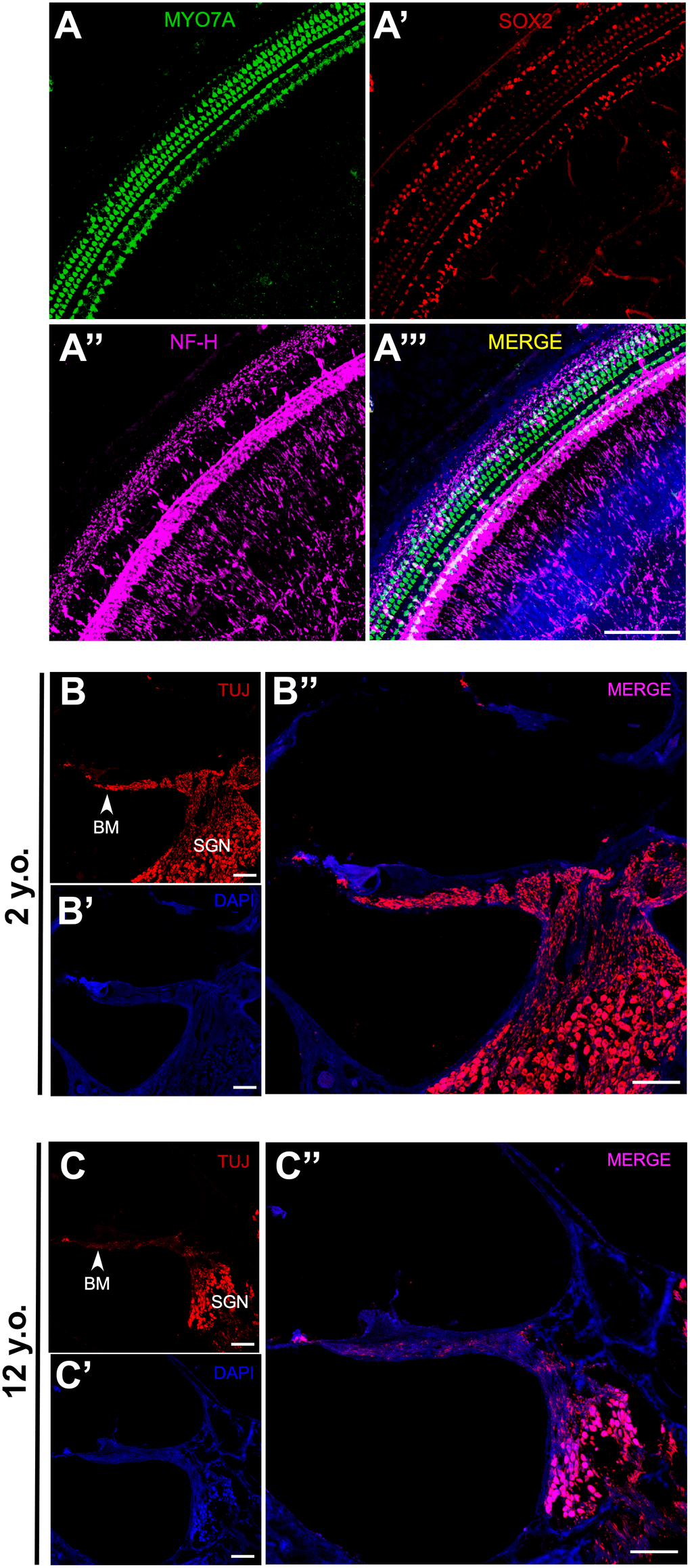 Effects of age on SGN density in marmosets. (A–A”) Confocal whole-mount immunofluorescence images of the middle turn of a cochlea in a 2-year-old marmoset. (A) Hair cells labeled with MYO7A. (A’) Supporting cells positive for SOX2. (A”) Neural fibers labeled with NF-H. (A”’) Merged channels figure, MYO7A (green), SOX2 (red), NF-H (magenta), DAPI (blue). (B–B”) Confocal images of a cochlear cryosection from a 2-year-old marmoset. SGNs labeled with TUJ. TUJ-positive neurofilaments connect the basilar membrane (BM) to the modiolus. (C–C”) Confocal images of a cochlear cryosection from a 12-year-old marmoset. Scale bar: 100 μm.