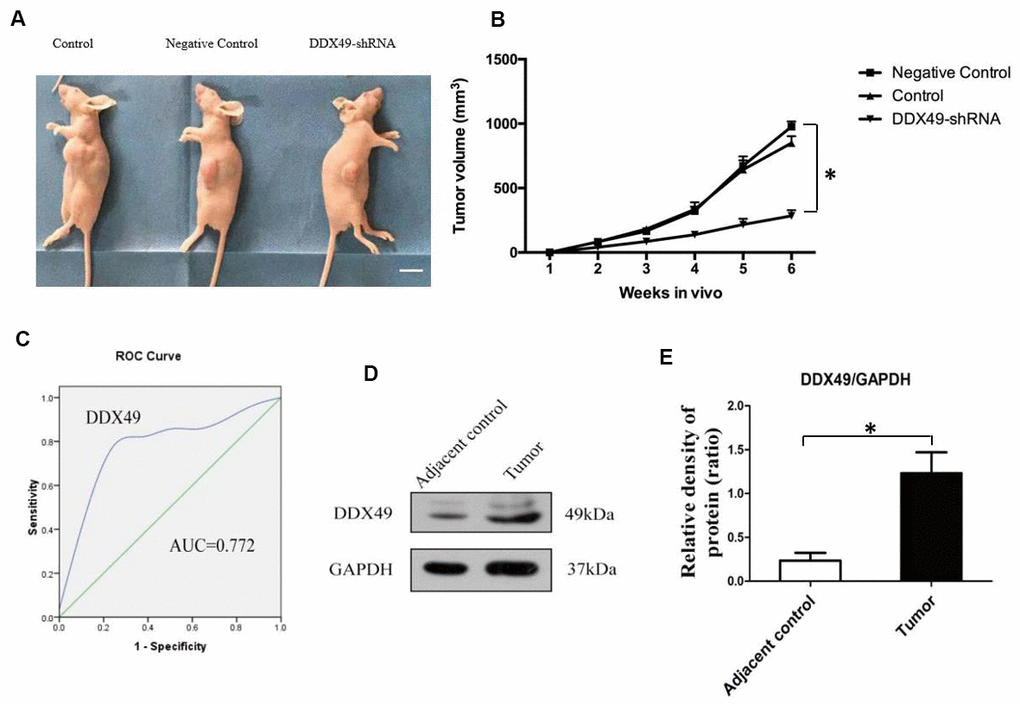 DDX49 expression and its effects on HCC xenografts in mice and HCC in patients. (A, B) QGY-7703 cells were transfected with DDX49-shRNA or negative-control shRNA, then injected into nude mice (N=8 animals/group). Control mice were nude mice inject with tumor cells. Scale bar, 1 cm. After 6 weeks, tumor volume was measured. (C) DDX49 expression in HCC patients was used to differentiate tumor tissue and normal liver tissue. (D, E) Western blot analysis of DDX49 in paired samples of tumor and normal liver tissue from HCC patients. *P 