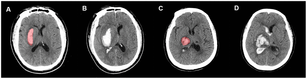 Representative illustration of new IVH, IVH expansion, and manual region of interest (ROI) segmentation. Images (A, B) are non-contrast CT images (axial view) of a 54-year-old male who experienced a new IVH. There was no baseline IVH (A), but the hematoma broke into ventricles on the follow-up CT (B). Images (C, D) are non-contrast CT images (axial view) of a 68-year-old female who experienced IVH expansion; (C) shows an initial IVH with a volume of 2.53 mL; follow-up CT (D) shows that the volume of IVH increased to 22.31 mL within 72 h.