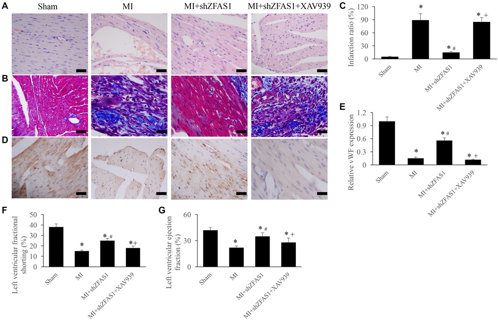 Inhibition of Wnt/β-catenin pathway remarkably reversed the influence of shZFAS1 on cardiac function. (A) Influence of XAV939 on the histological changes of MI rats myocardial tissues (Scale bar = 500 μm). (B) Influence of XAV939 on the collagen deposition of MI rats myocardial tissues (Scale bar = 500 μm). (C) Influence of XAV939 on the infarction ratio of MI rats myocardial tissues. (D) The expression of vWF in the MI rats myocardial tissues was measured using IHC staining (Scale bar = 500 μm). (E) Influence of XAV939 on the vWF expression in the MI rats myocardial tissues. (F) Influence of XAV939 on the left ventricular fractional shortening of MI rats. (G) Influence of XAV939 on the left ventricular ejection fraction of MI rats. *P #P 