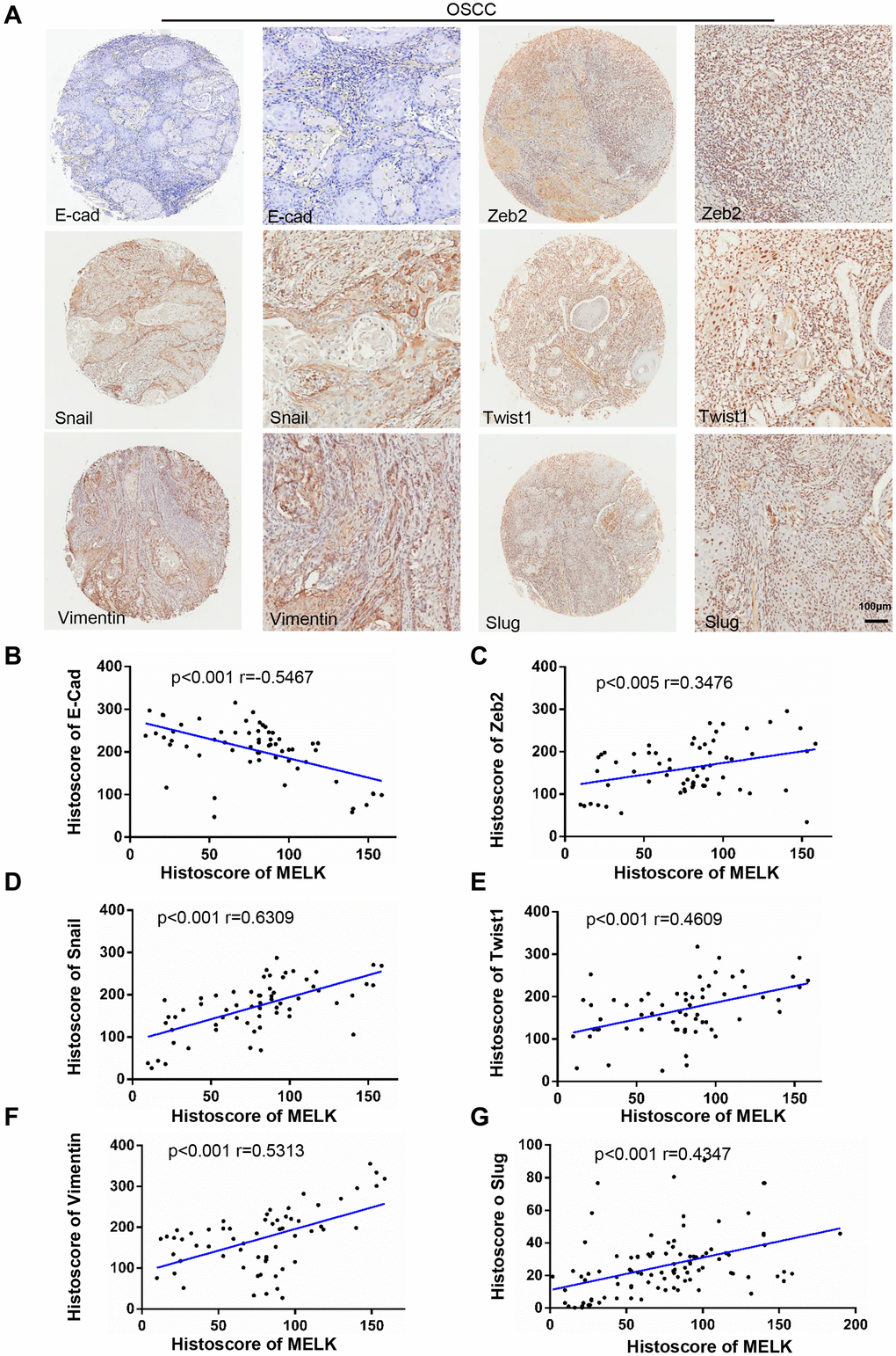 Increased MELK expression was associated with EMT markers in human OSCC tissues. (A) Typical images of IHC staining about N-cad, Zeb2, Snail, Twist1, Vimentin and Slug in human OSCC tissues. Scale bars:100 μm. (B–G) Correlation analysis among MELK and EMT-related proteins by Pearson’s correlation test based on the immunohistochemistry results.