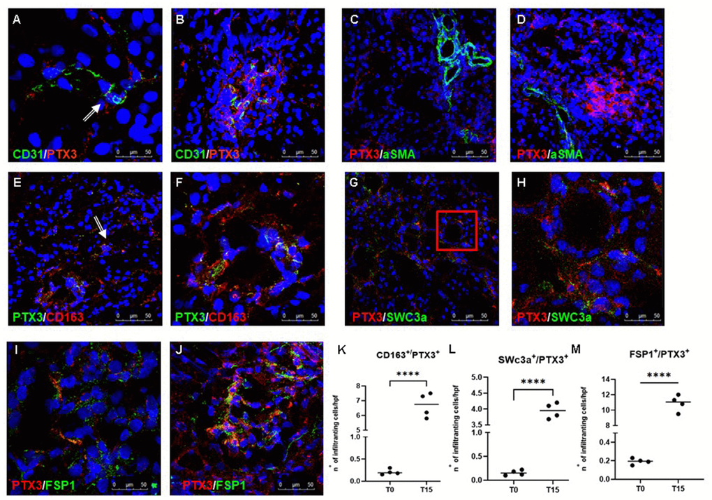 Characterization of the PTX3-associated cellular pattern in I/R injury. Frozen pig kidney sections were analyzed by indirect immunofluorescence to characterize the PTX3 source after 15 min of reperfusion. Co-localization between CD31 and PTX3 on renal EC was evident (A, B yellow staining). Activated myofibroblasts identified by alpha-smooth muscle actin (green) were negative for PTX3 (red; α-SMA+/PTX3-, C, D). Monocytes/macrophages identified by CD163 (red) co-localized with PTX3 (green; CD163+/PTX3+ yellow, (E) particular of E, F). Dendritic cells identified by SWC3a (green) were intensively positive for PTX3 (red; SWC3a+/PTX3+ yellow, (G) particular of G, H). Myofibroblasts identified by fibroblast-specific protein 1 (FSP1, red) co-localized with PTX3 (green; FSP1+/PTX3+ yellow, I, J). Nuclei were highlighted with TO-PRO 3 in blue. Original magnifications were x630. Quantification of CD163+/PTX3+ (K), SWC3a+/PTX3+ (L) and FSP1+/PTX3+ (M) cells demonstrated a statistically significant increase after 15 min of reperfusion compared to basal biopsies. Results were expressed as mean ± s.d. of infiltrating cells/high power field (hpf). *p