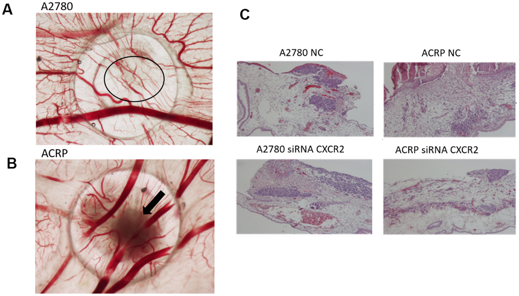 CXCR2 promotes in vivo OC tumor growth (TG), angiogenesis and tumor invasion.In vivo investigation of the role of CXCR2 on tumor growth, invasion and angiogenesis in OC was assessed by chicken embryo chorioallantoic membrane (CAM) method. (A) The number of new vessels formation with diameter lower than 20μm growing radially towards the ring area was counted in a blind fashion manner. No differences were noted between the lineages under the referred experimental condition. (B) Tumor size was measured at E10 egg inoculation with A2780 and ACRP OC cells, as: i) NC; ii) siRNA CXCR2 KD cells. Statistic significant difference were not observed probably due to number of replicates performed. However, when compared to A2780, TG was higher in ACRP than in A2780 cells. Moreover, CXCR2 KD prevented TG in later. The overall mortality rate for embryos/eggs was as expected (~10%). (C) The figure is also of a distinct invasion patterns between NC and CXCR2 KD ACRP and A2780 cells.