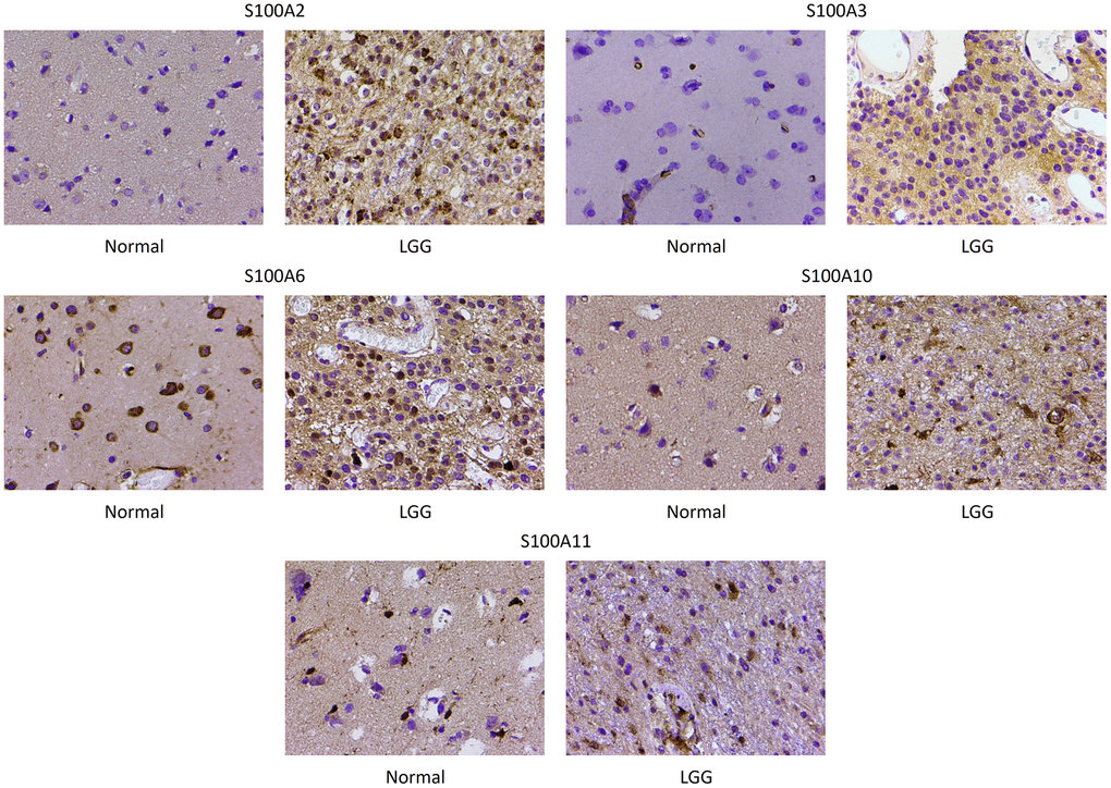Immunohistochemical staining of S100A2, S100A3, S100A6, S100A10 and S100A11 in normal brain and low-grade glioma. Magnification, ×200.