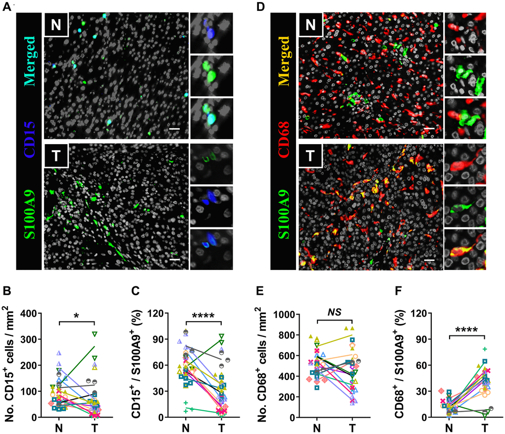 Myeloid cells are the major source of S100A9. Multiple immunofluorescence staining shows DAPI (gray), S100A9 (green), CD15 (blue, A), and CD68 (red, D) expression and coexpression (double-positive cells) in the N and T regions. Quantification of CD15+ (B) and CD68+ (E) cell densities in the T and N regions (n = 12). (C) The percentages of S100A9+CD15+ cells among the total S100A9+ cells in the N and T regions. (F) The percentages of S100A9+CD68+ cells among the total S100A9+ cells in the N and T regions. (n = 12). Scale bar = 25 μm. N, nontumor, T, tumor. *P ****P NS, no significance.