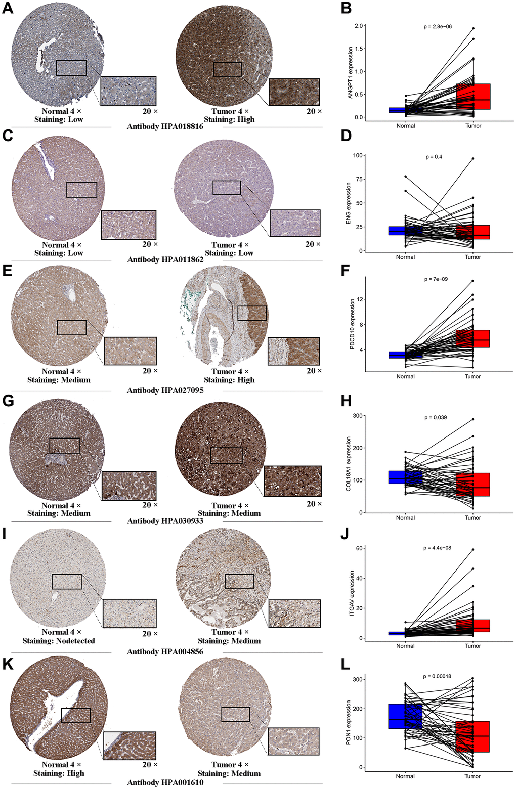 Human Protein Atlas immunohistochemistry of normal sample and tumor sample. The expression levels of ANGTP1 (A, B), ENG (C, D), PDCD10 (E, F), COL18A (G, H), ITGAV (I, J) and PON1 (K, L) in tumor and normal tissues were validated in the TCGA cohort, using the paired expression of the same individual normal tissue and tumor tissue.
