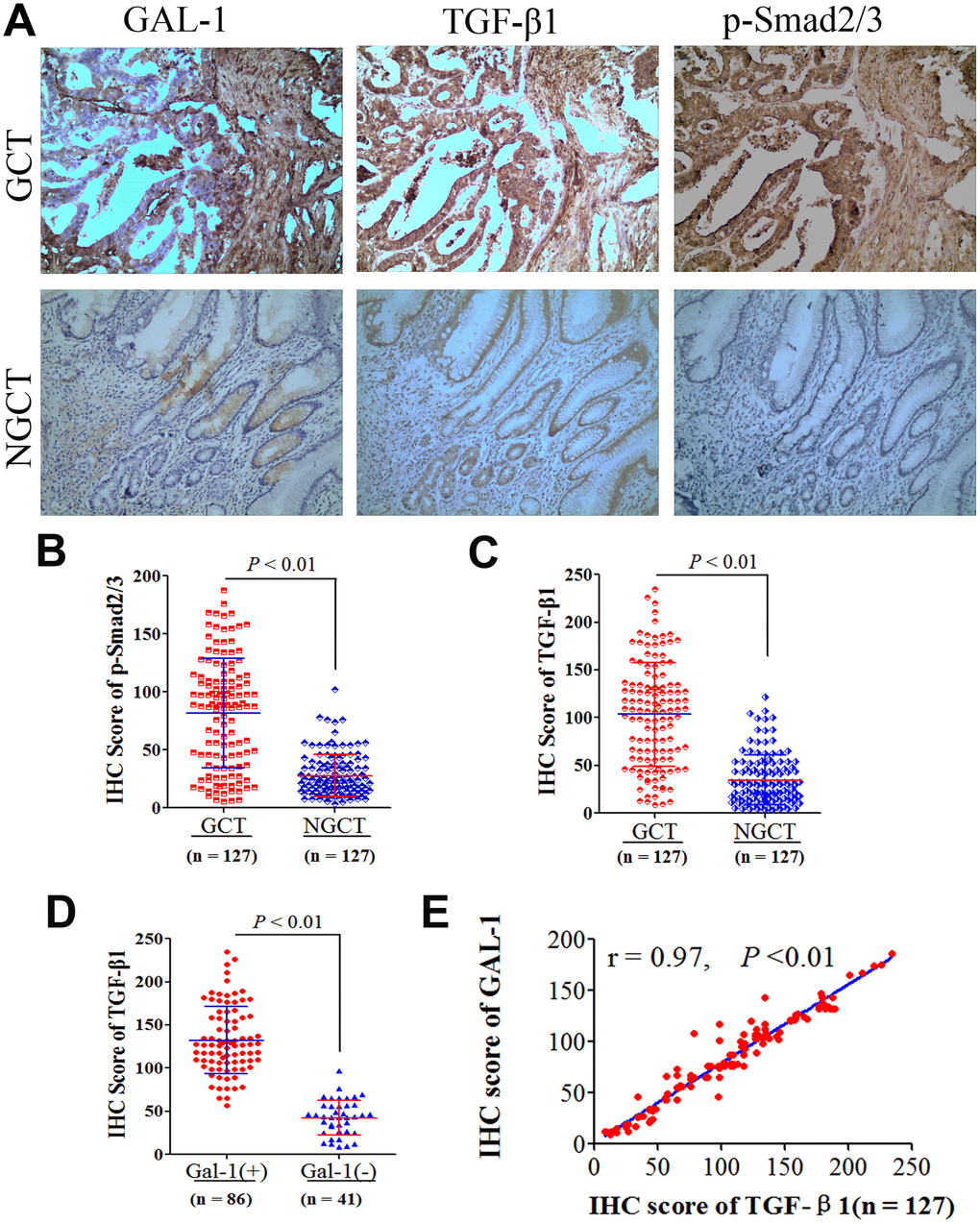 GAL-1/LGALS1 activates TGF-β/Smad signaling pathways in GC tissues. (A) Representative images of IHC for GAL-1, TGF-β1, and p-Smad2/3 protein levels in GCT and NGCT. Magnification: ×400. (B, C) Significant differences in TGF-β1 and p-Smad2/3 levels were observed between GCT and NGCT (all P D) The TGF-β1 IHC scores in GAL-1-positive GCT were significantly higher than those in GAL-1-negative GCT (P E) The TGF-β1 IHC scores correlate positively with the GAL-1 IHC scores in GC tissues (r = 0.97; P 