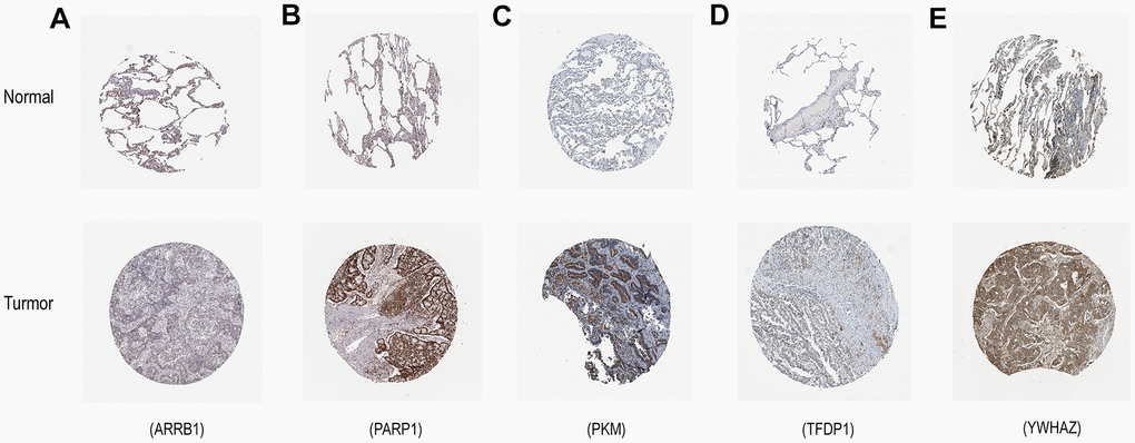 Verification of hub ERGs expression in LUAD and normal lung tissue using the HPA database. (A) ARRB1, (B) PARP1, (C) PKM, (D) TFDP1, (E) YWHAZ.