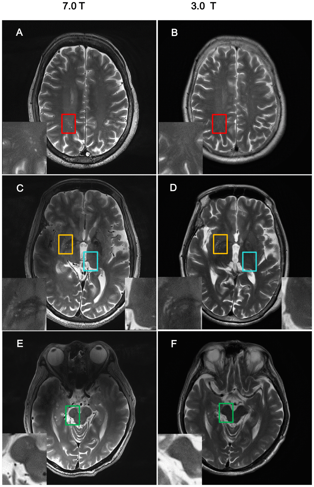 Comparison of imaging resolution between 7T and 3T MRI for nPVS. Example of comparisons of resolution of nPVSs on T2 weighted images acquired by 7.0T MRI vs 3.0T MRI on the same study participant. (A, B) Indicate centrum semiovale with red square; (C, D) indicate yellow squares for basal ganglia and blue squares for thalamus; (E, F) is midbrain with green squares. nPVS, normal-sized perivascular space.
