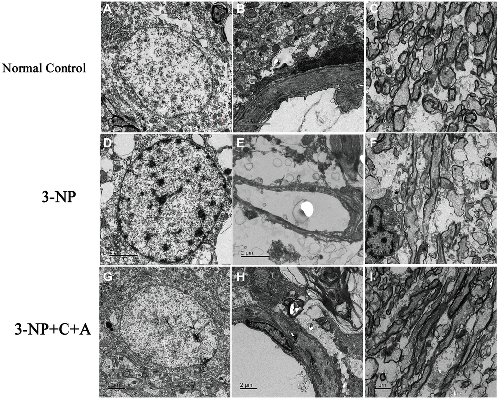 Treatment with C16+Ang-1 reduces neuronal apoptosis, vascular leakage and blood-brain barrier permeability. (A–C) Electron micrographs showing ultrastructural morphology of the normal group. (A) Normal neurons with well-defined nuclei and dispersed chromatin (euchromatin). (B) Blood vessels have intact tight junctions. There was no tissue edema or blood vessel leakage. (C) Normal myelinated axons. (D–F) Changes in ultrastructural morphology in the 3-NP-treated group. (D) Neuronal apoptosis was evidenced by nuclei with condensed, fragmented, and marginated chromatin against the nuclear envelope compared with normal cells. (E) Leakage from severe blood vessels and tissue edema in the extracellular space. (F) Myelin sheath splitting, loosening, and fusion, and vacuoles were observed. (G–I) In the 3-NP+C16+Ang-1 group, the morphology of (G) nuclei was relatively normal. (H) Perivascular edema and (I) myelin sheath splitting were reduced.