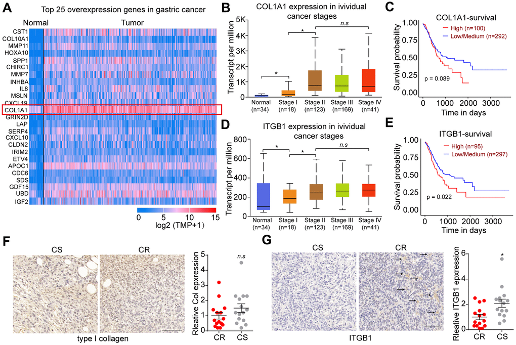 Integrin β1 promoted gastric cancer progression. (A) Top 25 overexpression genes in gastric tumor tissues comparing with normal tissues analyzed by TCGA database. (B) The relative expression of COL1A1 in normal tissues and gastric tumor tissues (stage I, II, III and IV) analyzed by TCGA database. (C) The overall survival of gastric cancer patients with low/high COL1A1 expression analyzed by TCGA database. (D) The relative expression of ITGB1 in normal tissues and gastric tumor tissues (stage I, II, III and IV) analyzed by TCGA database. (E) The overall survival of gastric cancer patients with low/high ITGB1 expression analyzed by TCGA database. (F) Relative expression of type I collagen in chemo-sensitive (CS) and chemo-resistant (CR) tumor tissues from gastric patients, which was examined by immunohistochemistry (n=15). The scale bar is 100 μm. (G) Relative expression of ITGB1 in chemo-sensitive (CS) and chemo-resistant (CR) tumor tissues from gastric patients, which was examined by immunohistochemistry (n=15). The scale bar is 100 μm. *Indicates P 