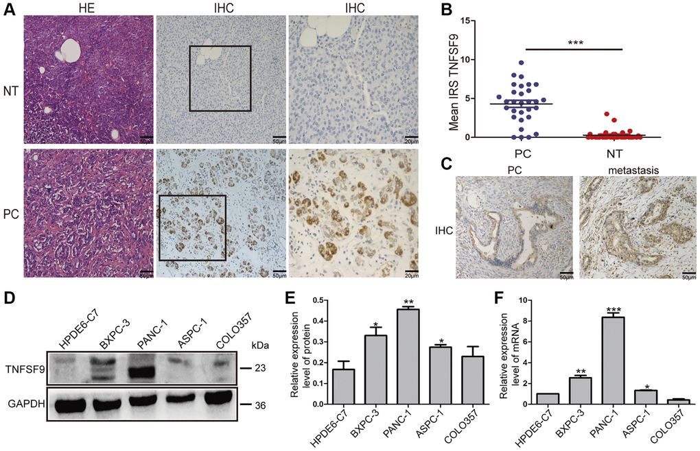 The expression of TNFSF9 in pancreatic cancer tissues is significantly higher than that in non-tumor tissues adjacent to cancer. (A) Representative HE staining and immunohistochemical staining pictures of cancer tissues and non-tumor tissues adjacent to pancreatic cancer (n = 30) and immune response score (B). (C) Immunohistochemical staining pictures of pancreatic cancer tissue with metastasis and pancreatic cancer tissue without metastasis. (D, E) Western blot analysis of the protein expression of TNFSF9 in pancreatic cancer cells COLO357, ASPC-1, PANC-1 and BXPC-3 and normal pancreatic epithelial cells HPDE6-C7. (F) QPCR analysis of the mRNA expression of TNFSF9 in COLO357, ASPC-1, PANC-1, BXPC-3 and HPDE6-C7. NT, non-tumor tissue adjacent to pancreatic cancer. PC, pancreatic cancer. IRS was used to evaluate tissue staining. The staining intensity is 0 to 3 points, 0 is no staining, 1 is low staining, 2 is medium staining, and 3 is high staining. The percentage of positive cells ranges from 0 to 4 points, 0 80%. *P **P ***P 