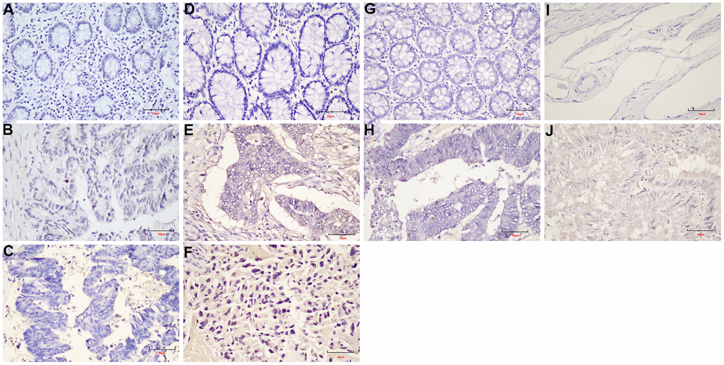 The expression of LEF1 in FFPE samples. (A) DST-LRRC; (B) DST-PRC; (C) DST-rectal tissue; (D) LZQ-LRRC; (E) LZQ-PRC; (F) LZQ-rectal tissue; (G) LHC-NRRC; (H) LHC-rectal tissue; (I) SCC-NRRC; (J) SCC-rectal tissue. Scale bar=50μm.