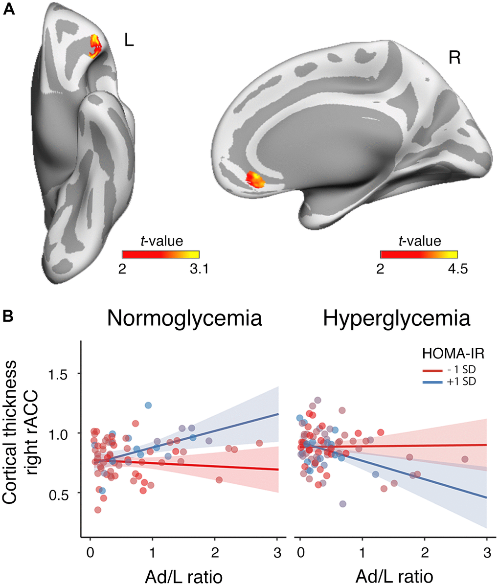 Moderating role of HOMA-IR and glycemia in the association between the Ad/L ratio and cortical thickness. (A) Results of the three-way interaction (Ad/L ratio × HOMA-IR × glycemia) after adjustment for the remaining MtbS components, CRF, BMI, age, sex and years of education. Significant t statistic values were projected into the inflated cortical surfaces (L: left; R: right). (B) Scatterplot to represent the post-hoc of the three-way interaction effect shown in panel (A). It shows the association of the Ad/L ratio with cortical thickness in the rostral anterior cingulate (rACC) of the right hemisphere at 1 SD below and above the mean of HOMA-IR for participants showing normal blood glucose levels (left panel) and hyperglycemia (right panel). The shaded areas reflect the confidence intervals (95%) for the fitted values.