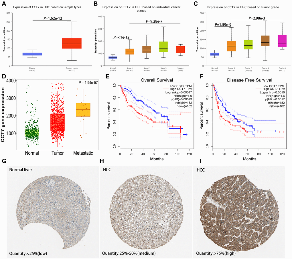 CCT7 levels in HCC and adjacent normal liver tissues. (A) CCT7 mRNA levels were significantly greater in HCC than in normal liver tissues. (B, C) CCT7 mRNA expression increased incrementally with increasing cancer stages (B) and tumor grades (C) in HCC tissues. (D) CCT7 mRNA levels were greater in metastatic than in non-metastatic tumor samples. (E, F) Higher CCT7 mRNA expression was associated with worse OS (E) and RFS (F). (G–I) Representative images from immunohistochemical staining of CCT7 protein expression in normal liver tissues (G, expression quantity H, expression quantity 25–50%) and high-expression HCC tissues (I, expression quantity >75%) from the Human Protein Atlas database.