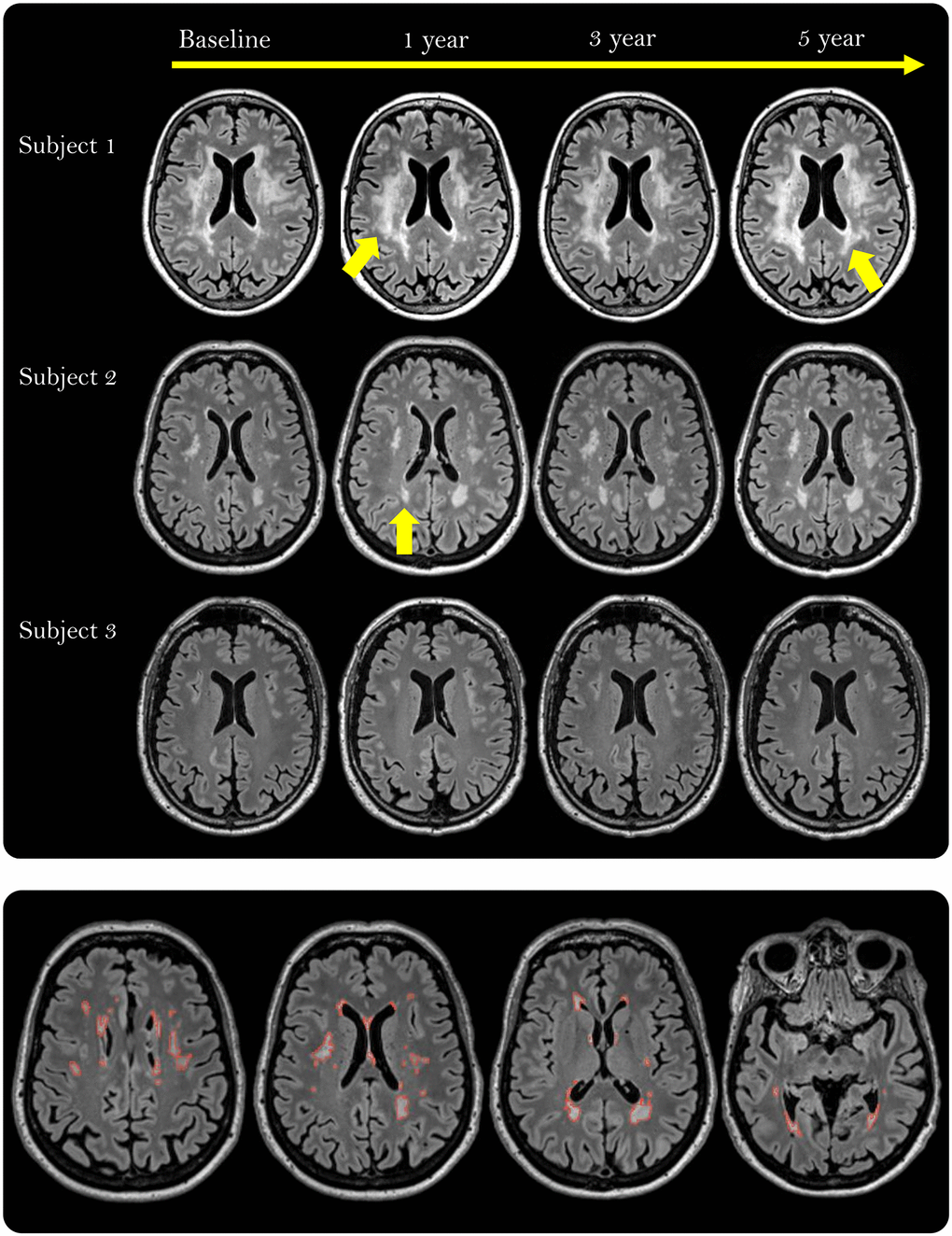 White matter hyperintensities (WMHs) depicted as white, well-defined lesions or confluent areas in white matter on fluid-attenuated inversion recovery (FLAIR) scans in three participants during the 5-year intervention period. The yellow arrows point to areas with growing WMH lesions (Subject 1) or a new lesion (Subject 2). The lower row shows the manually delineated WMHs (red outline) across 4 out of 176 slices in one participant.