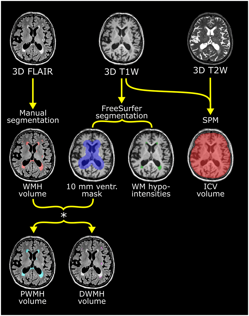 Flow chart of the multiparametric analysis of the brain MRI scans exemplified with scans from one participant. Upper row shows the 3D FLAIR, T1- and T2-weighted scans used. See Table 10 for scan details. Manual segmentation of white mater hyperintensities (WMH) was performed on the FLAIR images. From the T1-weighted scan, the ventricular (ventr.) mask derived with FreeSurfer (shown in violet in middle row) was used to stratify WMH into periventricular white mater hyperintensities (PWMH) (located 