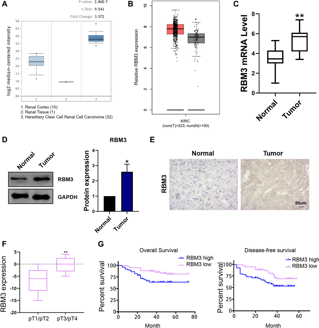 RBM3 level in ccRCC. (A) The expression of RBM3 was predicted based on the Oncomine database. (B) The expression of RBM3 was predicted based on the GEPIA database. (C) The expression of RBM3 in carcinoma and paracancerous tissues of 30 patients with ccRCC was detected by qRT-PCR. n = 30. (D) RBM3 protein in ccRCC and paracancerous tissues was detected using western blot. Representative image was shown on the left. Quantification data represented mean ± SD (normalized to adjacent tissue). n = 6. (E) Immunohistochemistry was used to detect RBM3 protein in renal cell carcinoma and paracancerous tissues. (F) The expression of RBM3 was analyzed by qPCR in the different stage of the patients. (G) The correlation of RBM3 expression with overall survival and disease-free survival of the patients was analyzed. Representative image was shown. *p **p 