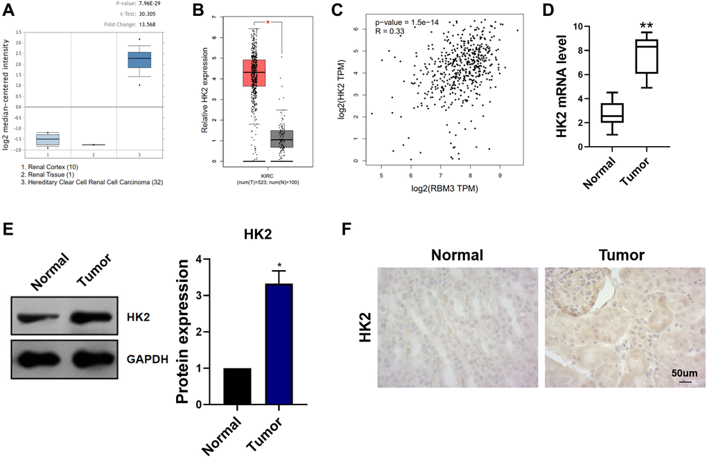 Expression of HK2 in ccRCC. (A) The expression of RBM3 was predicted based on the Oncomine database. (B) The expression of RBM3 was predicted based on the GEPIA database. (C) GEPIA database predicted the correlation between RBM3 and HK2 expression. (D) The expression of RBM3 in carcinoma and paracancerous tissues of 30 patients with renal cell carcinoma was detected by qRT-PCR. (E) The relative amount of the HK2 protein in ccRCC and paracancerous tissues tested by western blot, n = 4. (F) Representative immunohistochemistry image of the HK2 protein in ccRCC and paracancerous tissues. *p **p 