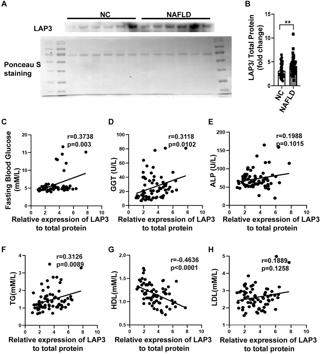 LAP3 was upregulated in the plasma of NAFLD patients. (A and B) The LAP3 expression in plasma of NAFLD patients and normal people was detected by western blotting (A) and normalized by serum total protein (B). (C–H) Correlation analysis between LAP3 and clinical indexes of NAFLD by Graph prism 8.0. Data were presented as means ± SD. *p **p ***p t-test was performed to determine the statistical significance. Abbreviations: NAFLD: Nonalcoholic fatty liver disease; NC: normal healthy control; GGT: γ-glutamyltranspeptidase; ALP: alkaline phosphatase; TG: triglyceride; HDL: high-density lipoprotein; LDL: low-density lipoprotein.