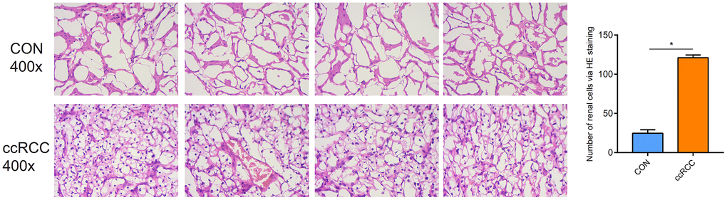 Pathological morphologic changes of ccRCC via the HE staining.