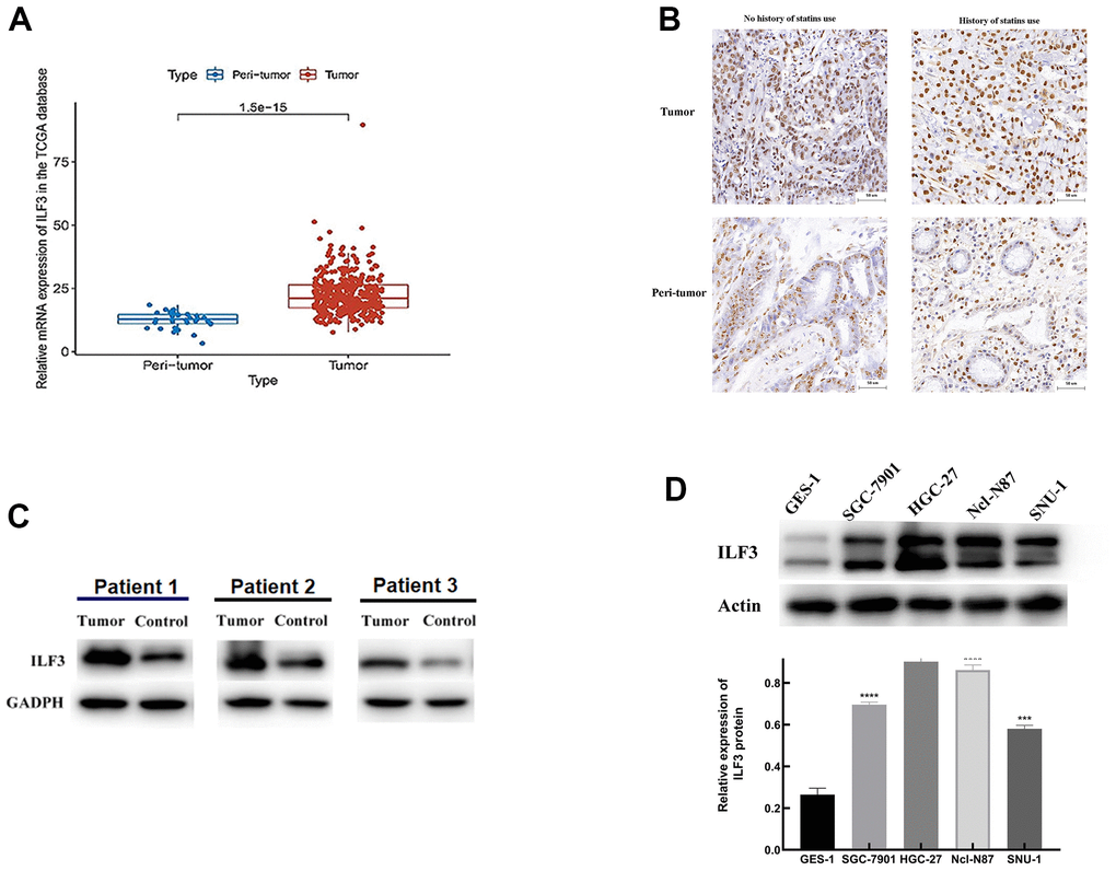 ILF3 was up-regulated in gastric cancer. (A) Expression of ILF3 mRNA in gastric cancer samples (n = 375) and normal samples (n = 32) from the TCGA data. (B) ILF3 protein expression was detected by IHC. ILF3 positive staining in tumor tissues was increased relative to non-cancerous tissues. (C) Western blot analysis of ILF3 in paired tumor tissues and non-cancerous tissues. The ILF3 expression level of mRNA was higher in cancer tissue than in normal tissues. (D) Western blot analysis of ILF3 protein in gastric epithelial cell line (GES-1) and gastric cancer cells lines (SGC-7901, HGC-27, Ncl-N87, and SNU-1). The ILF3 protein expression was significantly higher in gastric cancer cell lines than gastric epithelial cell line. **P 