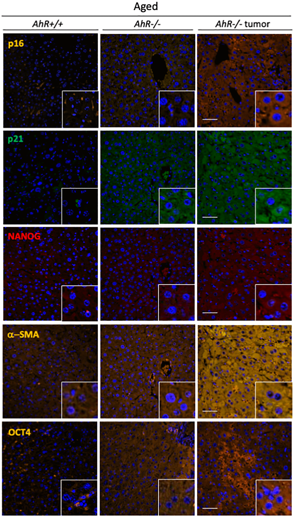AhR−/− livers overexpress senescence and undifferentiation/stemness markers. Protein levels of senescence markers p16Ink4 and p21Cip1 and pluripotency/stemness inducers NANOG and OCT4 were analyzed by immunofluorescence in liver sections of aged AhR+/+ and AhR−/− mice and in hepatocarcinomas from AhR−/− mice. Expression of α-SMA was also analyzed as indicator of vasculogenesis. Conjugated secondary antibodies labelled with Alexa 488, Alexa 550 and Alexa 633 were used for detection. DAPI staining was used to label cell nuclei. An Olympus FV1000 confocal microscope and the FV10 software (Olympus) were used for the analysis. Scale bar corresponds to 50 μm.
