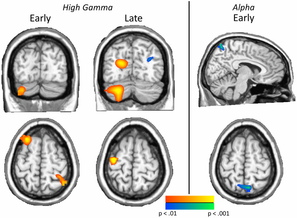 Neural switch costs differ by comorbidity status. Left: Significant group effects on neural switch costs were found in both time bins of high gamma, including the left cerebellum, left inferior (not shown) and superior frontal regions and the right parietal cortex in the early high gamma window, and left precentral, left occipital, left cerebellum, and right parieto-occipital regions in late high gamma activity. Right: Greater neural switch costs in early bin parietal alpha activity were found in type 2 diabetes patients with additional comorbidities, relative to those without comorbidities. These effects show the impact of comorbidities on neural switch costs across the spectrum. Images are thresholded from p p 3 voxels.