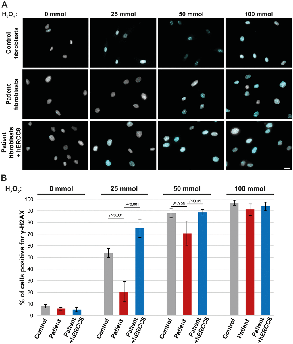 Rescue experiment: γ-H2AX staining of control, patient, and wtERCC8 transduced patient fibroblasts. (A) Cells were stained without as well as following H2O2 treatment in different concentrations. (B) At least three hundred cells per condition from three independent experiments were counted to quantify the number of cells positive for γ-H2AX.