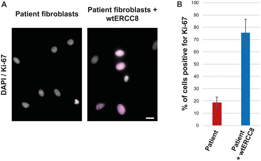 Rescue experiment: Ki-67 staining of patient and wtERCC8 transfected patient fibroblasts. (A) Untreated and transduced patient cells were stained to asses cell proliferation. (B) At least three hundred cells per condition from three independent experiments were counted to quantify the number of cells positive for the proliferation marker Ki-67.
