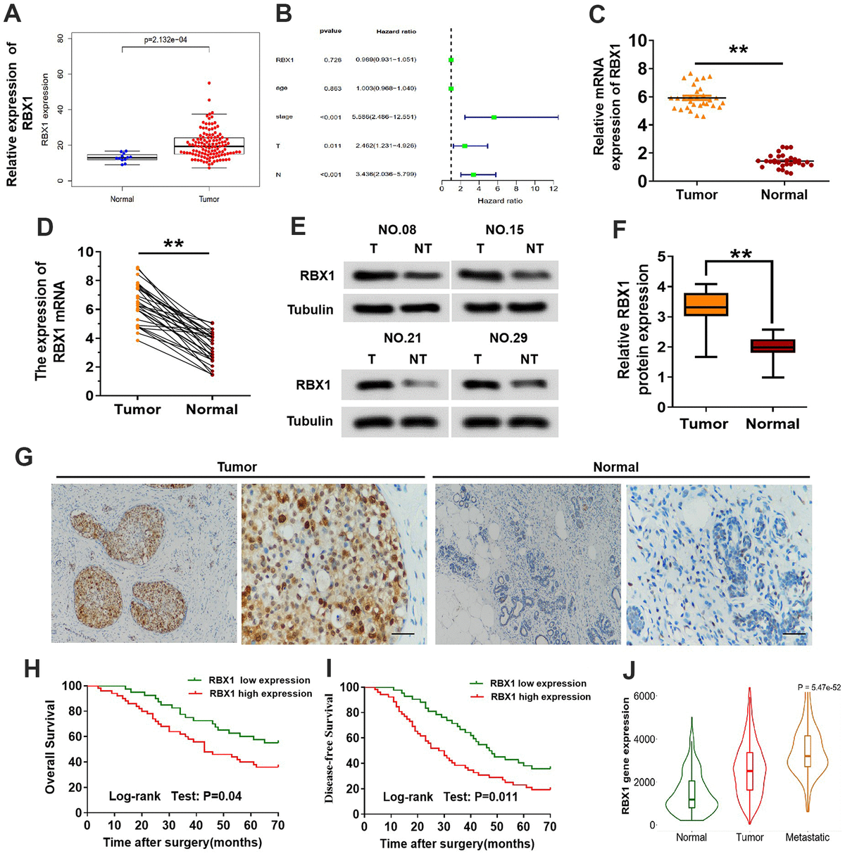 E3 Ubiquitin Ligase RBX1 Drives The Metastasis Of Triple Negative ...