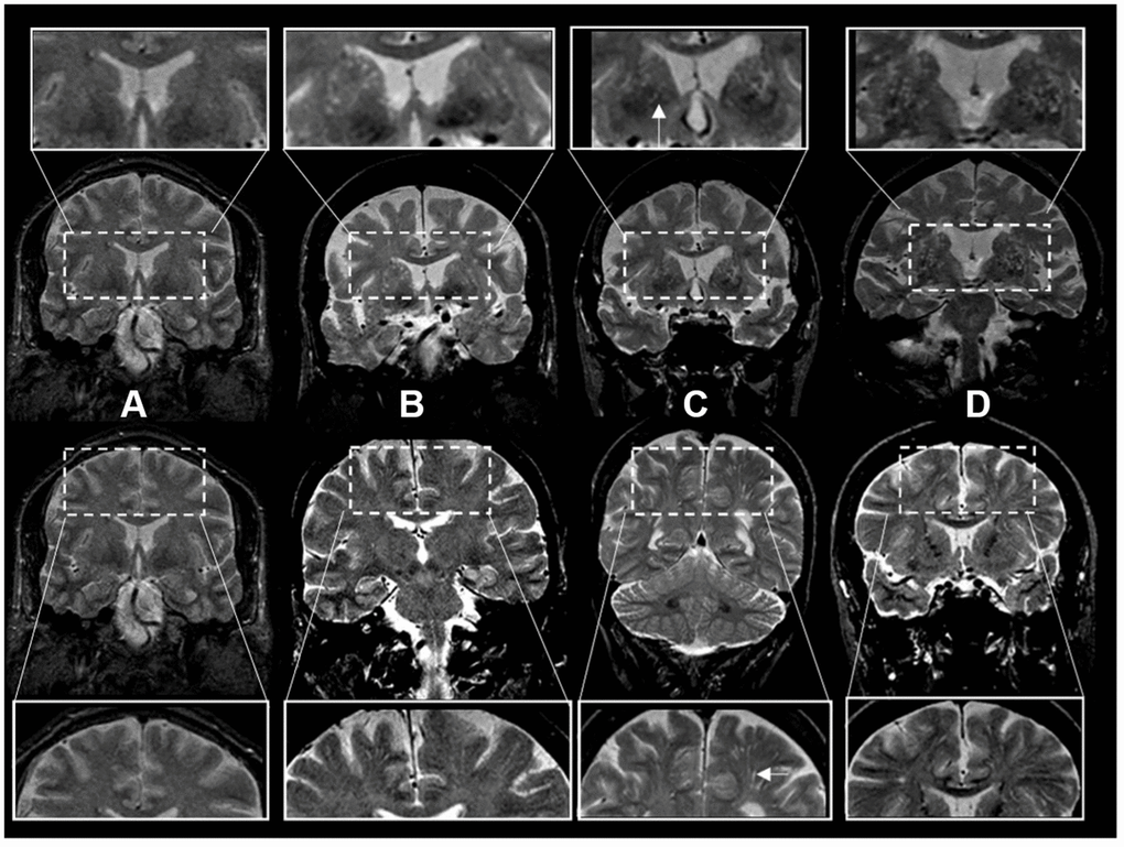 centrum semiovale mri