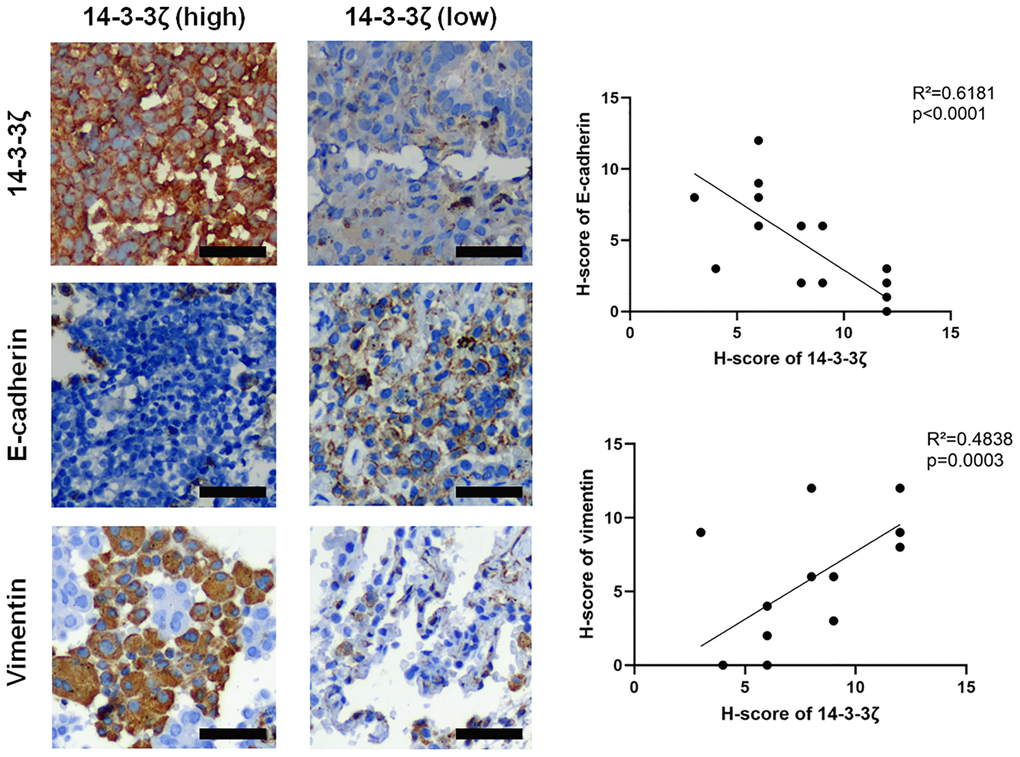 Representative IHC images of E-cadherin and vimentin in NSCLC tissues with different status of 14-3-3ζ. Scale bar = 200 μm. The linear regression analysis was used to determine the correlation between 14-3-3ζ, E-cadherin and vimentin, respectively.