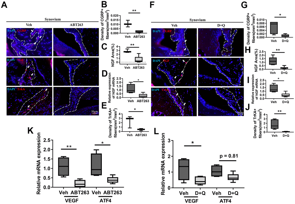 Senolytics treatment (ABT263 and D+Q) decreases the projection of nociceptive neuro-fiber in the synovium in spontaneous OA in aged mice. (A) Representative immunofluorescence images for CGRP, NGF, and TrkA in the synovium of 21 to 22-month-old mice were administered ABT263 or Veh (synovium indicated by dashed lines). Quantification of (B) density of CGRP+ nerve fibers (n = 3 mice for Veh, n = 5 mice for ABT263), (C) NGF positive area (n = 3 for Veh, n = 5 for ABT263), (D) relative mRNA levels of NGF in the joints (n = 4 for Veh, n = 7 for ABT263), and (E) density of TrkA+ nerve fibers in the mouse joint synovium (positive for each marker indicated by arrows) (n = 3 for Veh, n = 5 for ABT263). (F) Images of immunostaining of CGRP+ neuro-fibers, NGF expressions, and TrkA+ fibers. Quantitative analysis of the (G) density of CGRP+ sensory nerve fibers (n = 5 per group) and (H) NGF positive area in the synovium of aged mice administered D+Q (n = 5 for Veh, n = 7 for D+Q). (I) Relative mRNA levels of NGF in the joints (n = 4 for Veh, n = 6 for D+Q). (J) Quantitative analysis of the density of TrkA+ nerve fibers in the synovium of aged mice after D+Q administration (n = 5 for Veh, n = 7 for D+Q). Relative mRNA levels of VEGF and ATF4 in the joint of (K) ABT263 or Veh (n = 4 for Veh, n = 7 for ABT263) and (L) D+Q or Veh-treated older mice (n = 4 for Veh, n = 6 for D+Q). Whisker plots represent the 10th and 90th percentiles, and the line corresponds to the median. * p 
