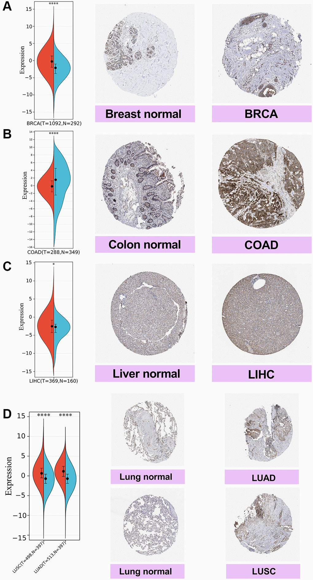 Comparison of SPIB expression in breast, colon, liver, and lung tissues by immunohistochemistry. (A) Breast tissue. (B) Colon tissue. (C) Liver tissue. (D) Lung tissue, including lung adenocarcinoma (LUAD) and lung squamous carcinoma (LUSC). For the violin plot, red is cancer samples and blue is normal samples. *P **P ***P ****P 
