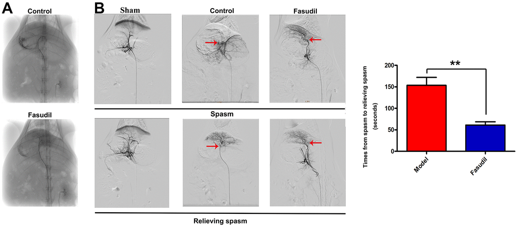 Fasudil relieved HA spasm in vivo. Fasudil or physiological saline was injected into the left medial lobe of the liver using a 16G lumbar puncture needle through the laparotomic route. (A) The celiac artery angiogram revealed that the animal models of HA spasm were successfully established. (B) The aortography demonstrated that there was a small spastic segment of the artery in Fasudil group. The quantitative analysis showed that Fasudil infusion reduced the duration from inducing to relieving spasm. Pvs. Model group.