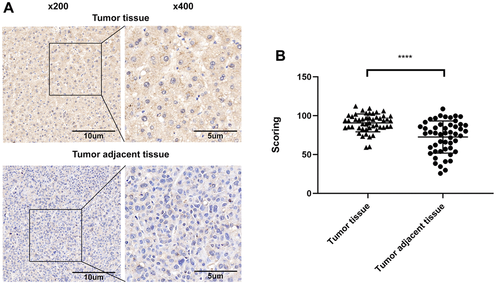 (A) Representative images of the immunohistochemical analysis of ALT1 in HCC tissue and matched non-tumor adjacent tissues. (B) IHC score values of ALT1 are significantly higher in HCC tissues compared to matched non-tumor tissues.