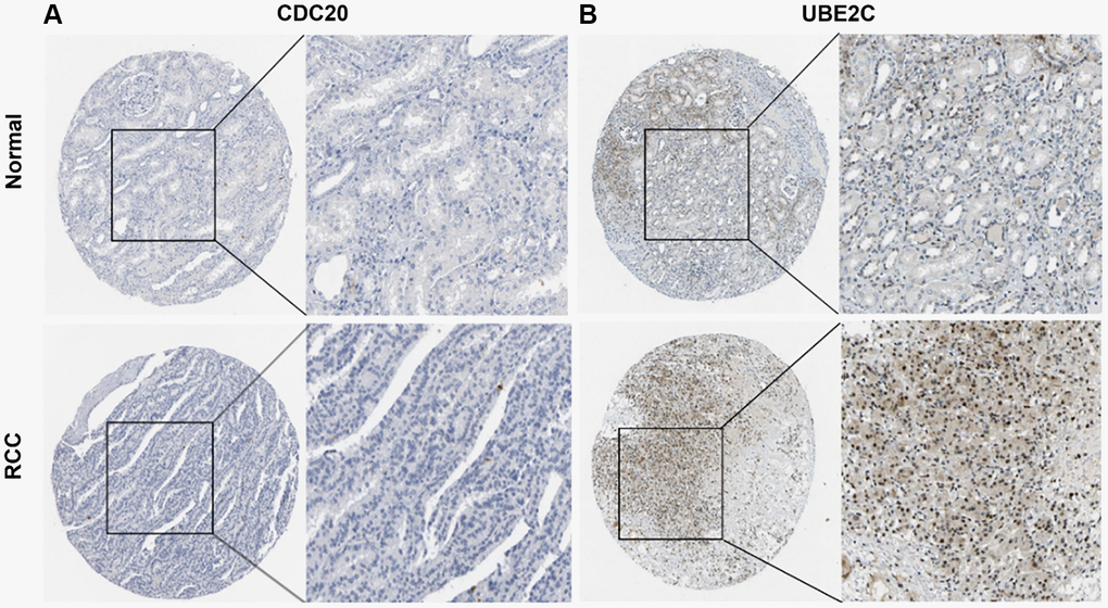 Representative immunohistochemistry images of risk genes in PRCC and non-cancerous renal tissues derived from the HPA database. (A) Validation of CDC20 by the human protein atlas database. (B) Validation of UBE2C by the human protein atlas database. Abbreviations: PRCC: papillary renal cell carcinoma; HPA: Human Protein Atlas.