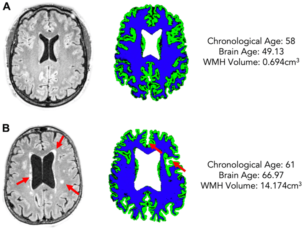White Matter Hyperintensity Load Is Associated With Premature Brain